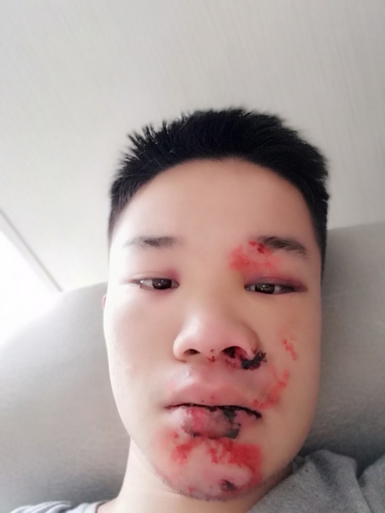 网贷惹的祸被打成这样

45 / 作者:神投手 / 