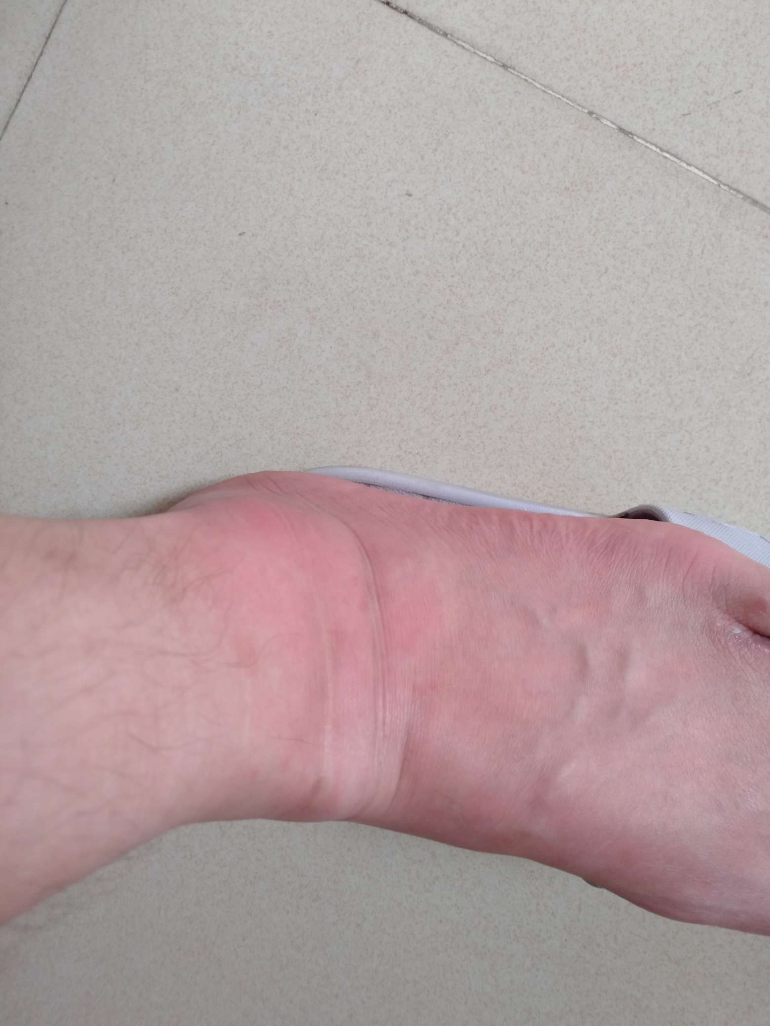 这蚂蚁真尼玛有毒，脚肿了不说还全这蚂蚁真尼玛有毒，脚肿了不说还全身过敏完36 / 作者:jeydhxh / 