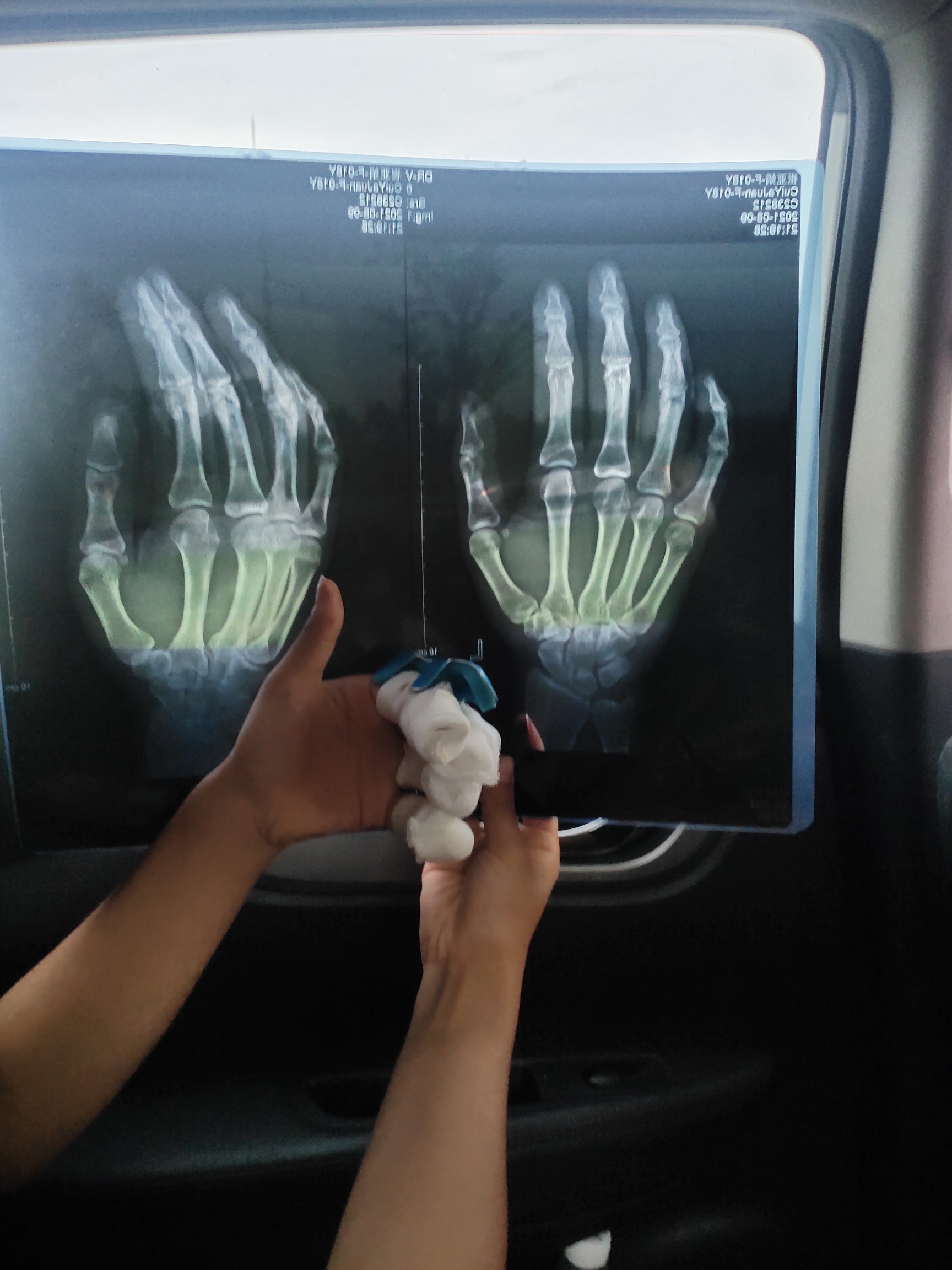 在工厂骨折，工伤申请下来了，社保局说做个鉴定保底十级工伤，老板也愿意赔偿，大概1277 / 作者:XJ. / 