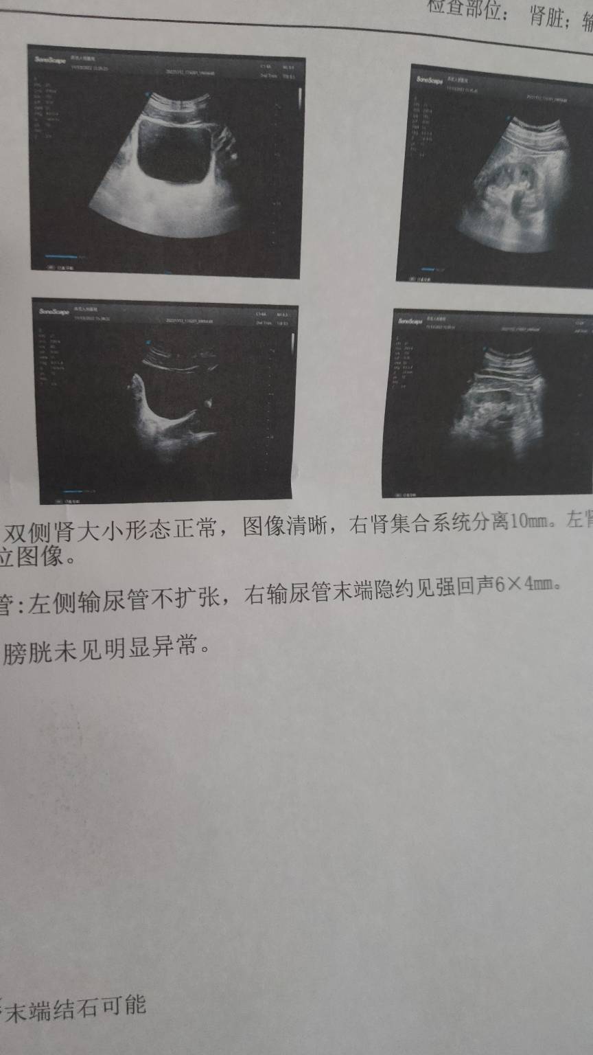 为了用掉美团券天天外卖，吃出结石了

19 / 作者:时光9527 / 