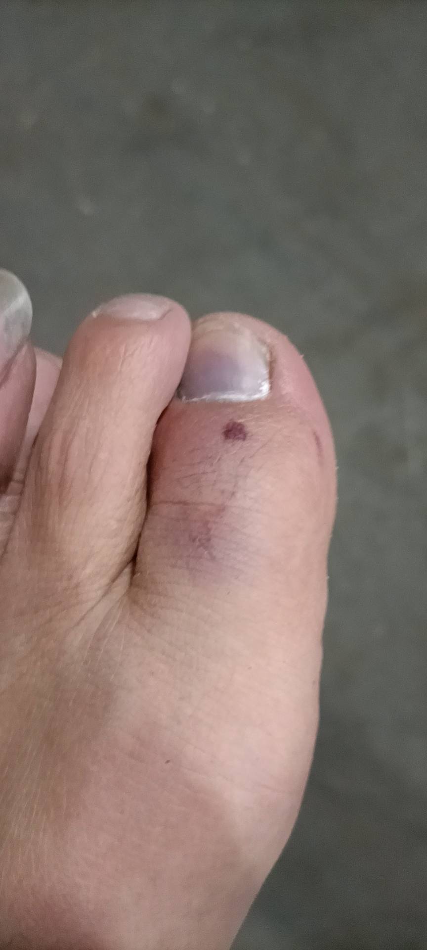 倒霉它妈给倒霉开门，(倒霉到家了?)德邦干日结，几百斤的货物直接砸脚上了

76 / 作者:时光路人的代表 / 