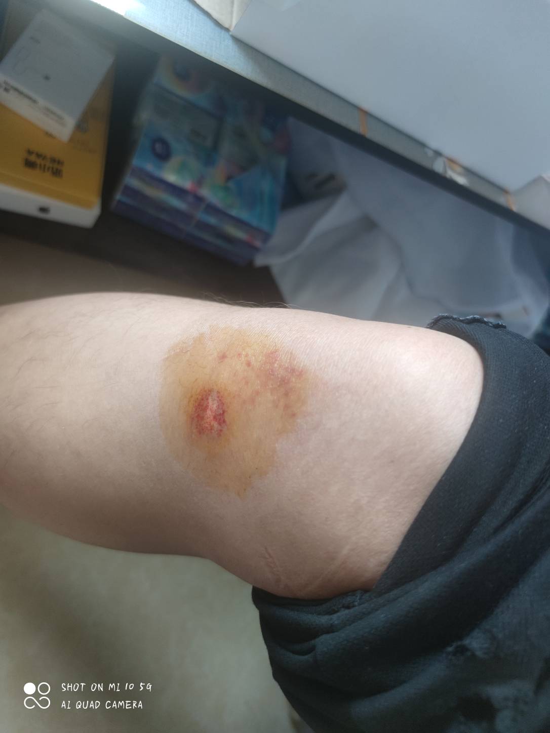 中午下班骑车回家路上被车撞了，小伤，赔了500毛。

13 / 作者:j一块去看看 / 