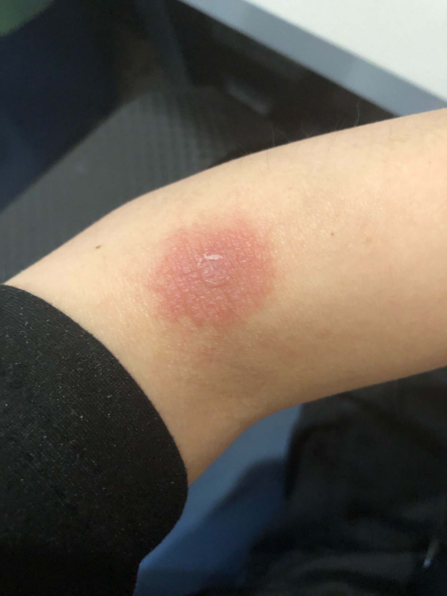 老哥们昨晚住酒店被虫子咬了可以找小美吗