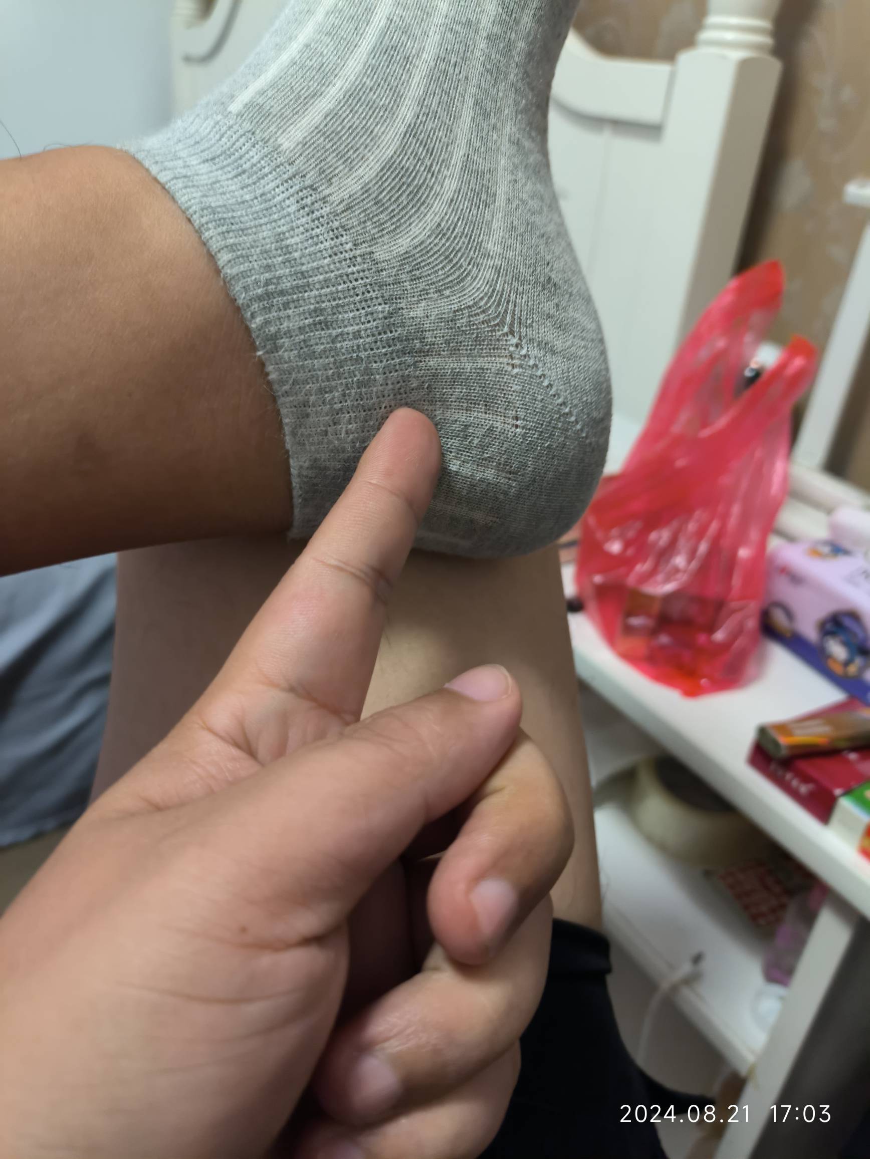 上个月跑了一会 然后脚腕往后勾里面就疼 平时走路也没啥事  一个多月了不知道是不是韧64 / 作者:摇摆的苏丹 / 