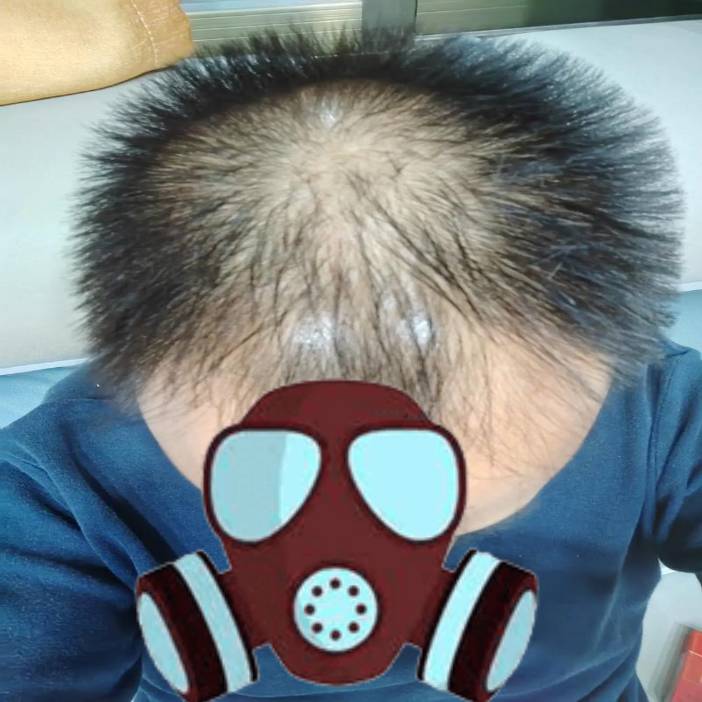 老哥们头发这样了还有救吗？现在都不敢出门怕别人嘲笑，每天都打2-3次，而且还天天熬14 / 作者:梵蒂冈海王八 / 