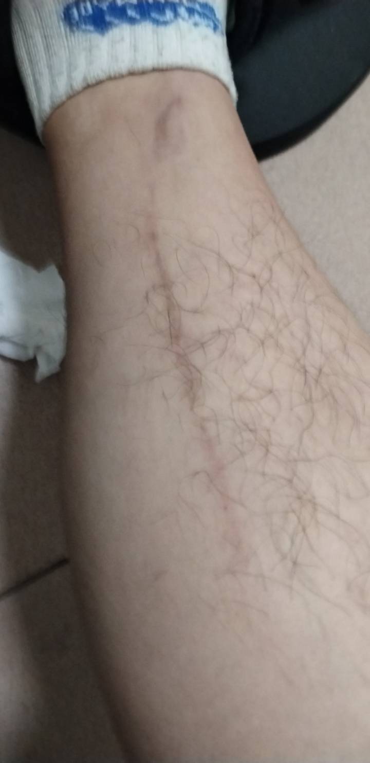 去年在长安上角，一个老头，50多岁，横穿马路撞了赔了400我，那个口子到现在还没好。31 / 作者:挂比了救我鸭 / 