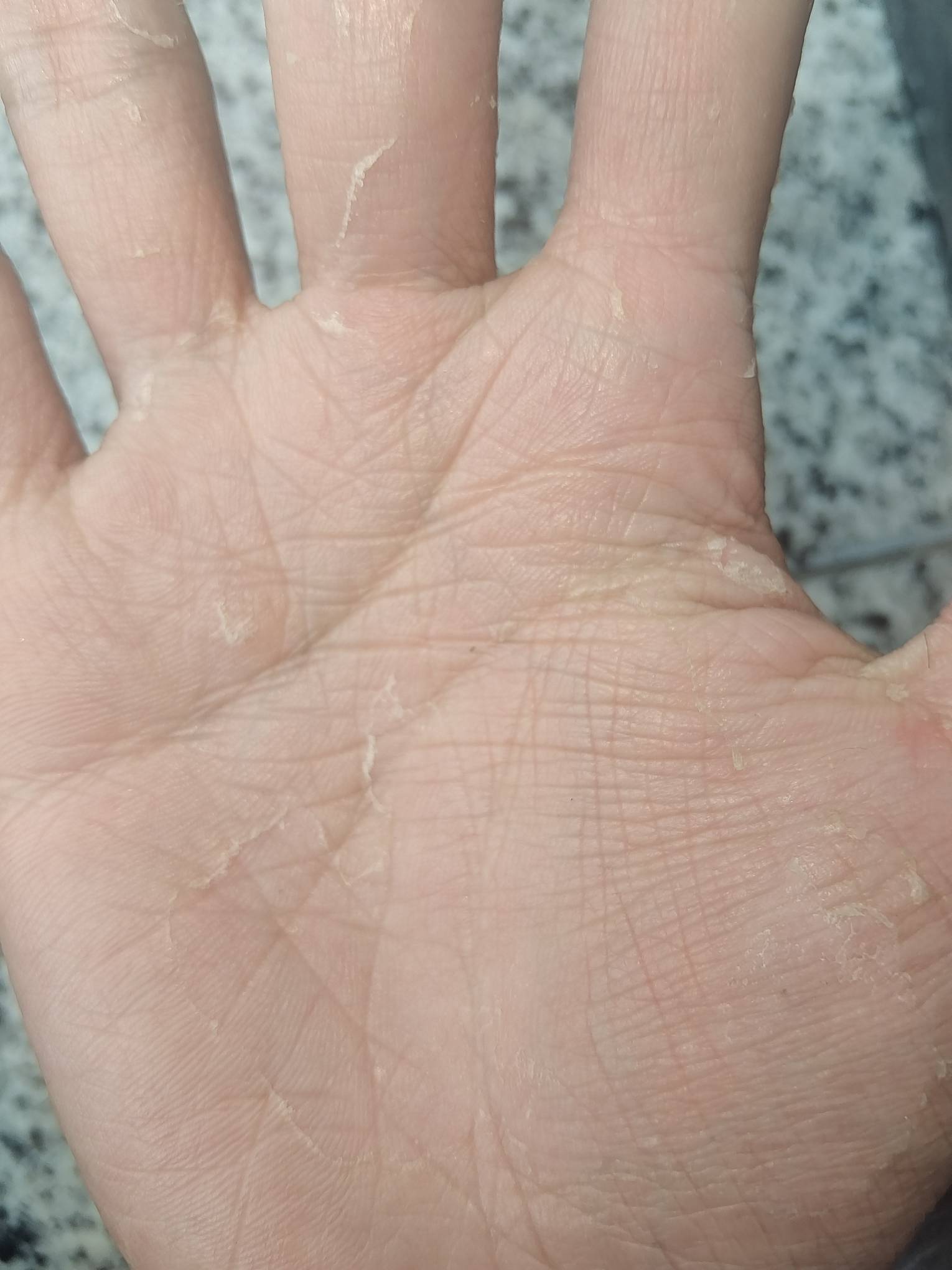 你们每年到这个时候手上会不会换一层皮，我今年手上已经给我撕下来一多半了
72 / 作者:烤机ggg / 