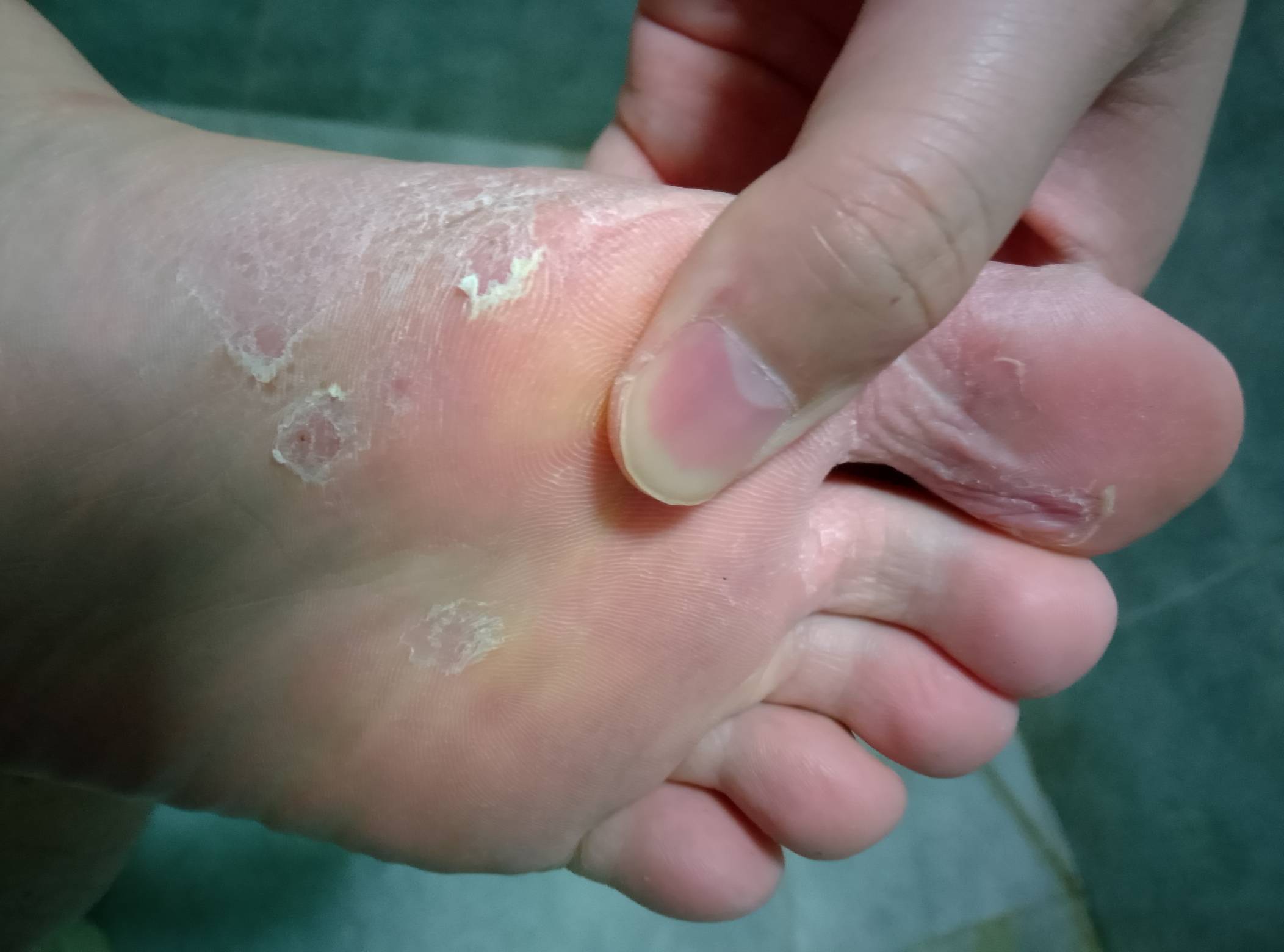 脚也没味道啊。网上查说是脚气，症状是褪皮干皮。有老哥经历过吗。啥药膏好点。
32 / 作者:墨镜探长 / 