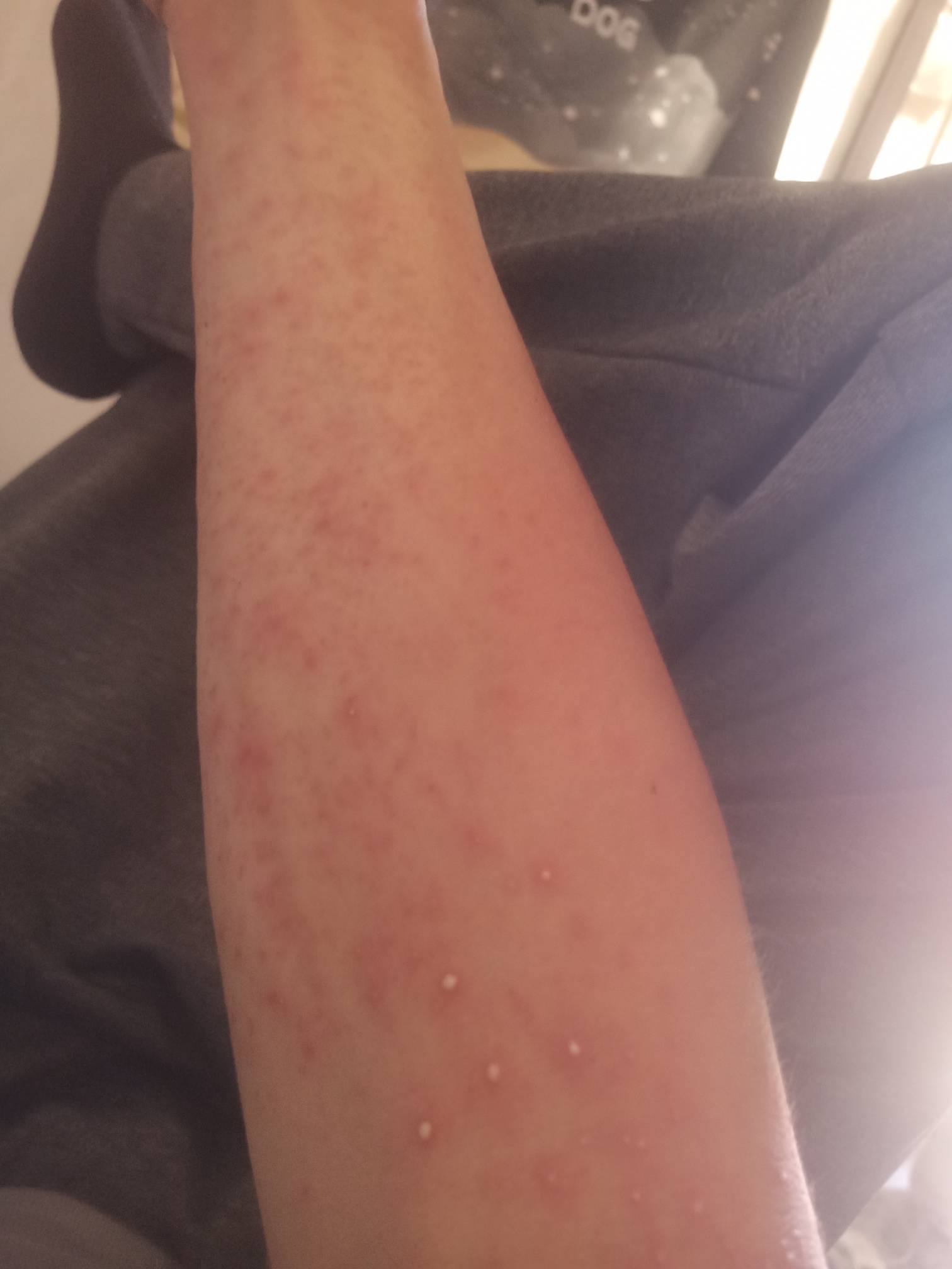 蚊子叮，臭虫咬受不了了，满身的红包，感觉浑身都痒，怎么办呀，以前住700一个月独立16 / 作者:晒晒月亮 / 