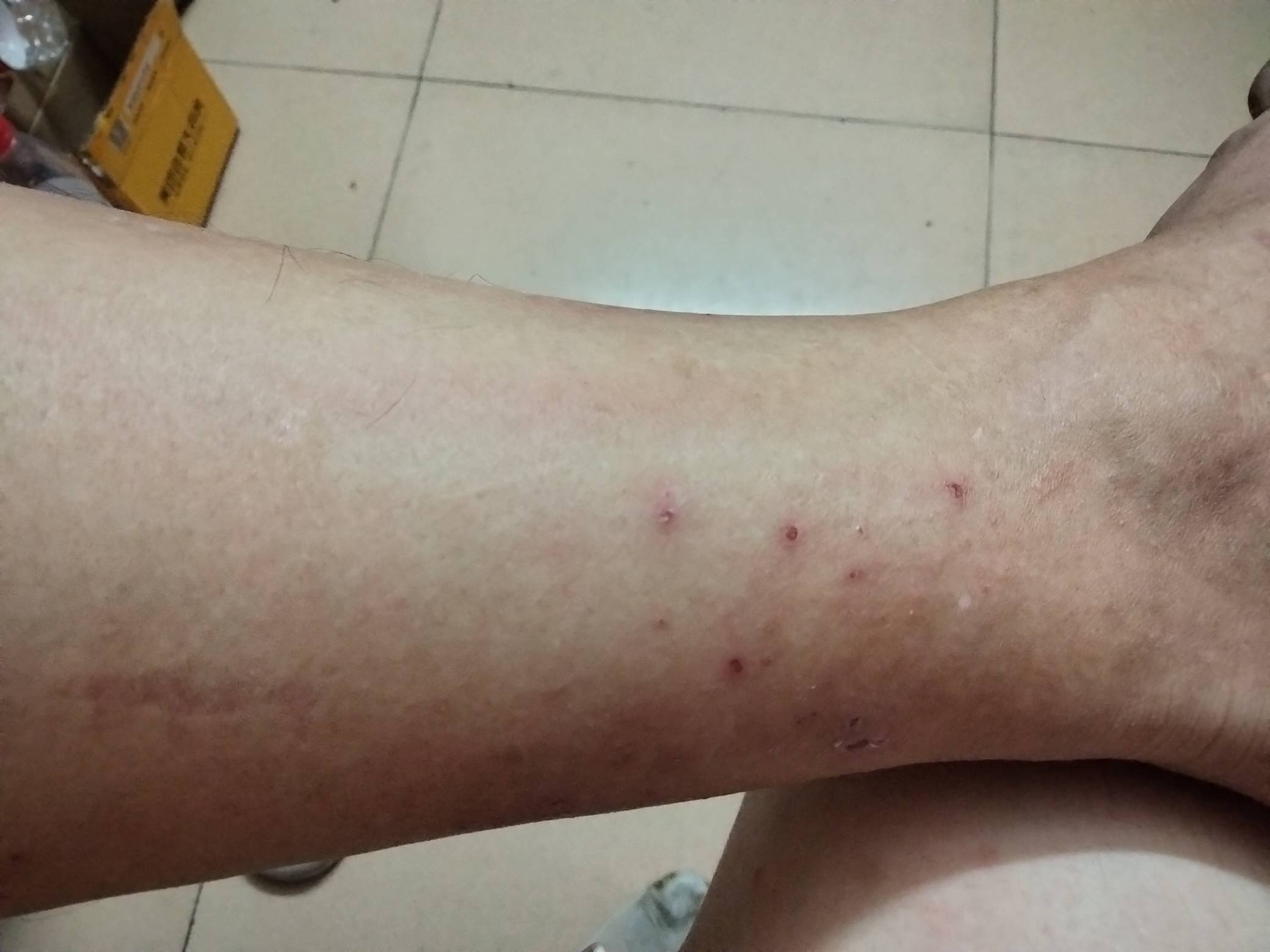 前段时间被蚊子咬了很痒就抓了几次，两只脚都是这样，长了很多小水泡，越抓越痒，买药66 / 作者:我要发财. / 