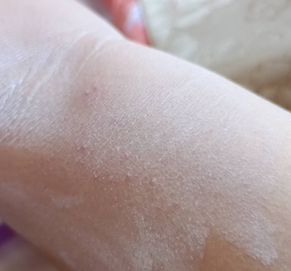 大腿内侧长了湿疹，好痒不敢扣，我搞了一把盐直接搓，那酸爽比打飞坤还爽，过后痛的哇0 / 作者:生蚝熟了 / 