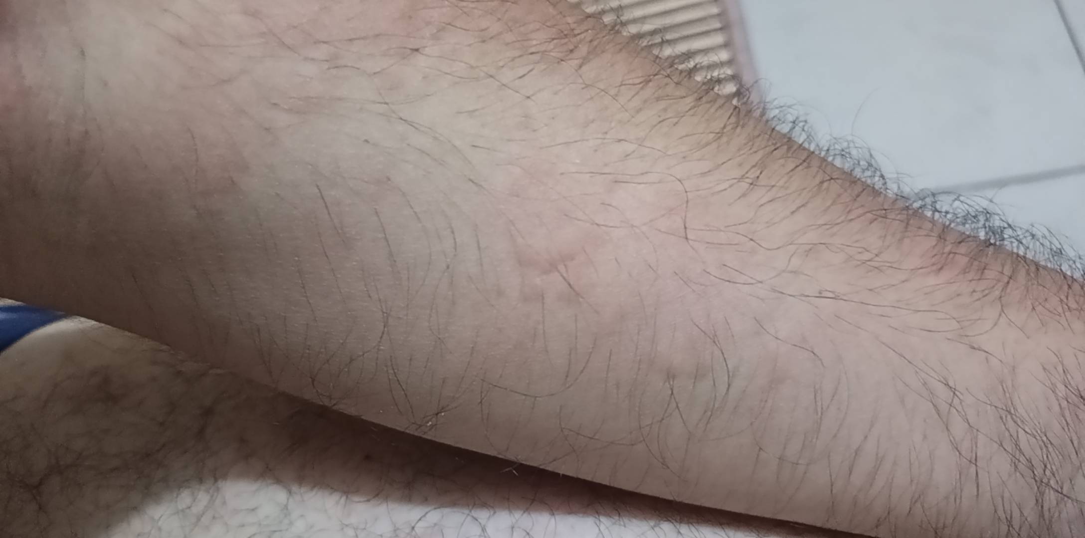 老哥们，有知道这种什么皮肤病，昨天晚上突然，身上出现和蚊子咬的包一样，非常的痒，47 / 作者:小爪哇 / 
