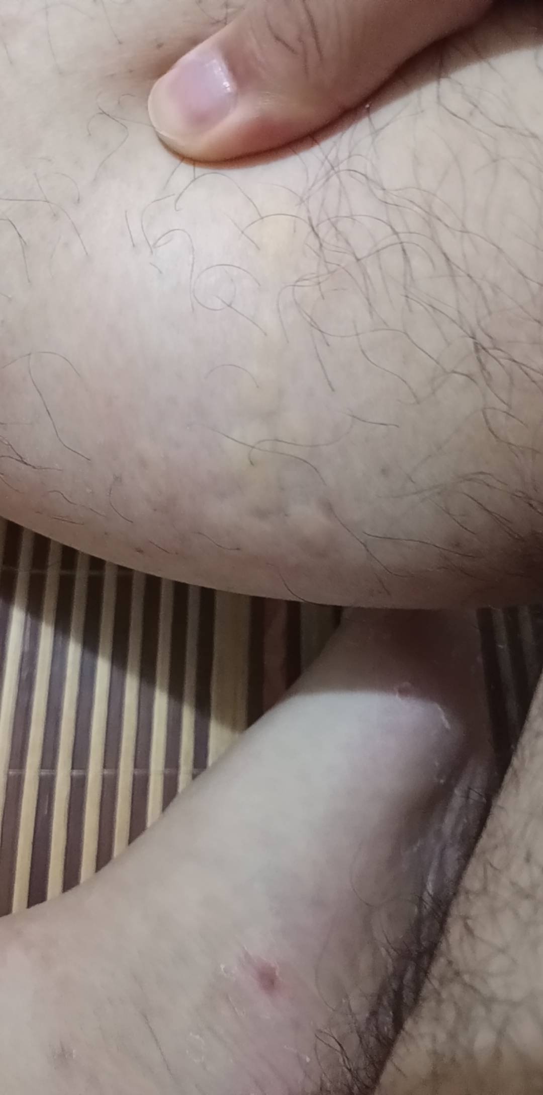 老哥们，有知道这种什么皮肤病，昨天晚上突然，身上出现和蚊子咬的包一样，非常的痒，13 / 作者:小爪哇 / 