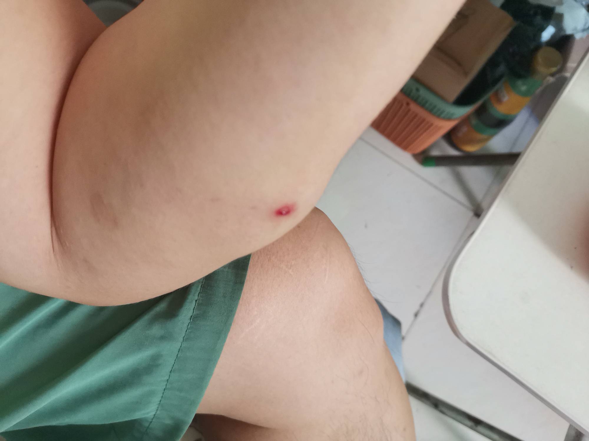 肿得这么大了，手直接砍到楼梯边上


86 / 作者:浪花的泡沫、 / 