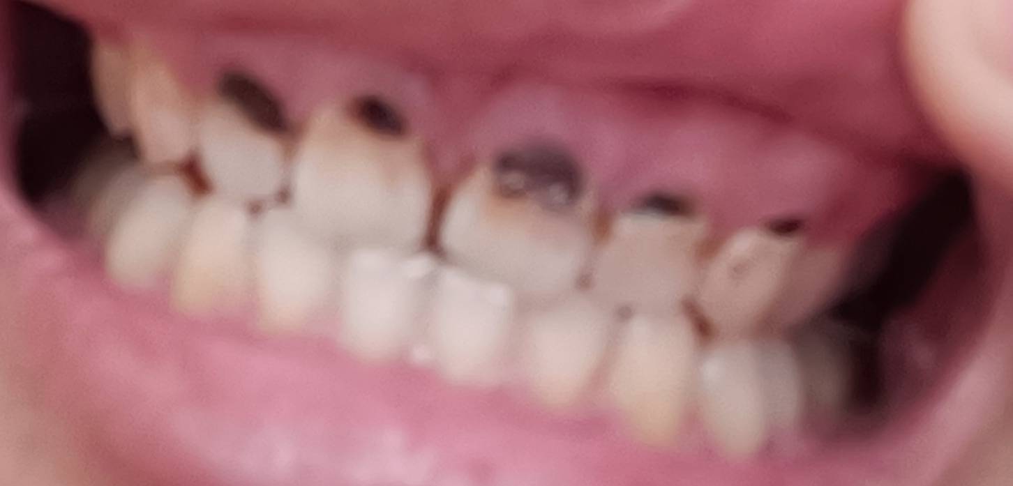 有没有懂行的老哥，像我这种牙齿根部外层坏掉的，去补需要多少钱一颗？，一共有5颗坏60 / 作者:挂壁老哥饿了mm / 