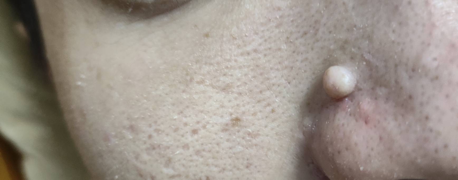  兄弟们，你们感觉有必要切嘛，在鼻子也有七八年了，一直也没咋关注，最近有点焦虑

79 / 作者:竹舟 / 