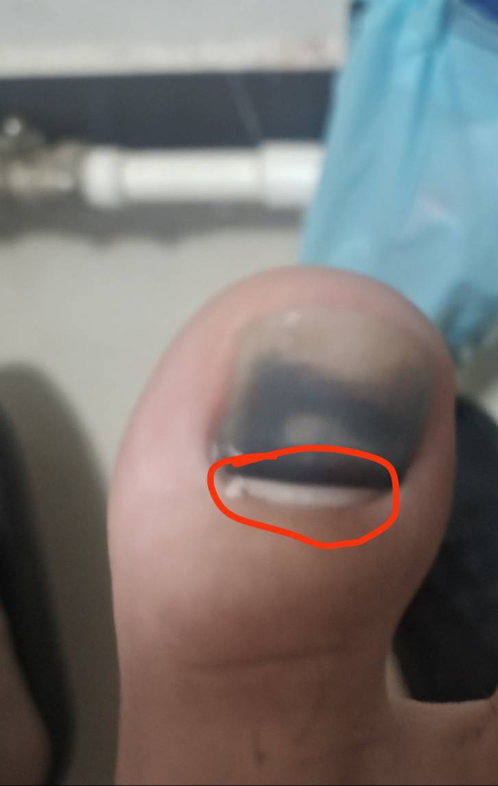 老哥们，之前受伤，右脚大拇指指甲盖马上脱落了，圈出来的白色是新长出来的指甲，只长96 / 作者:随随便 / 
