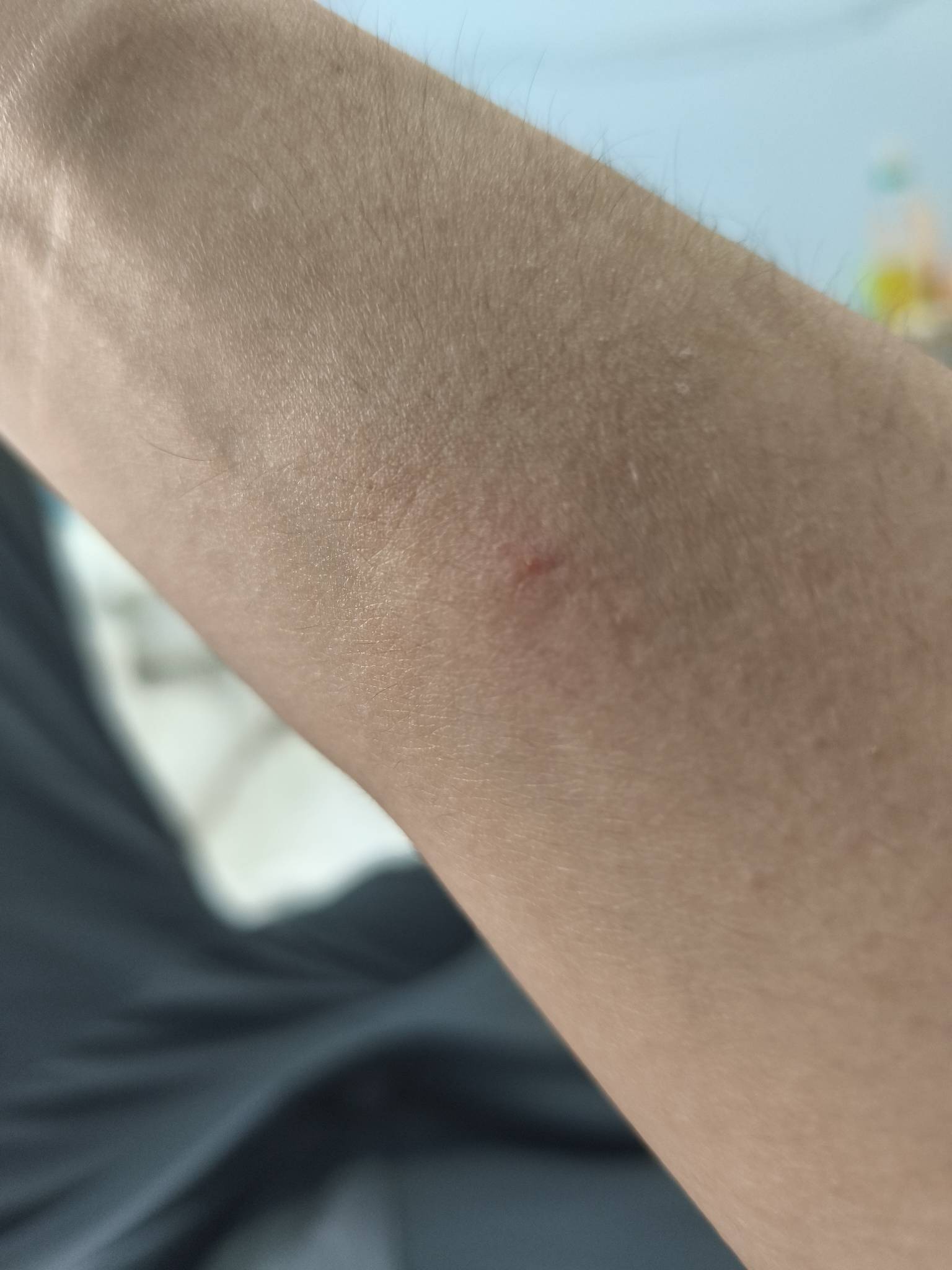 不知道什么东西咬的，两个包痒的一笔


45 / 作者:恭喜发财zy / 
