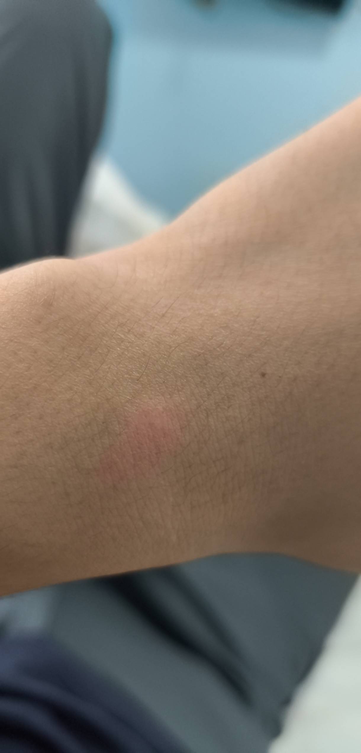 不知道什么东西咬的，两个包痒的一笔


86 / 作者:恭喜发财zy / 