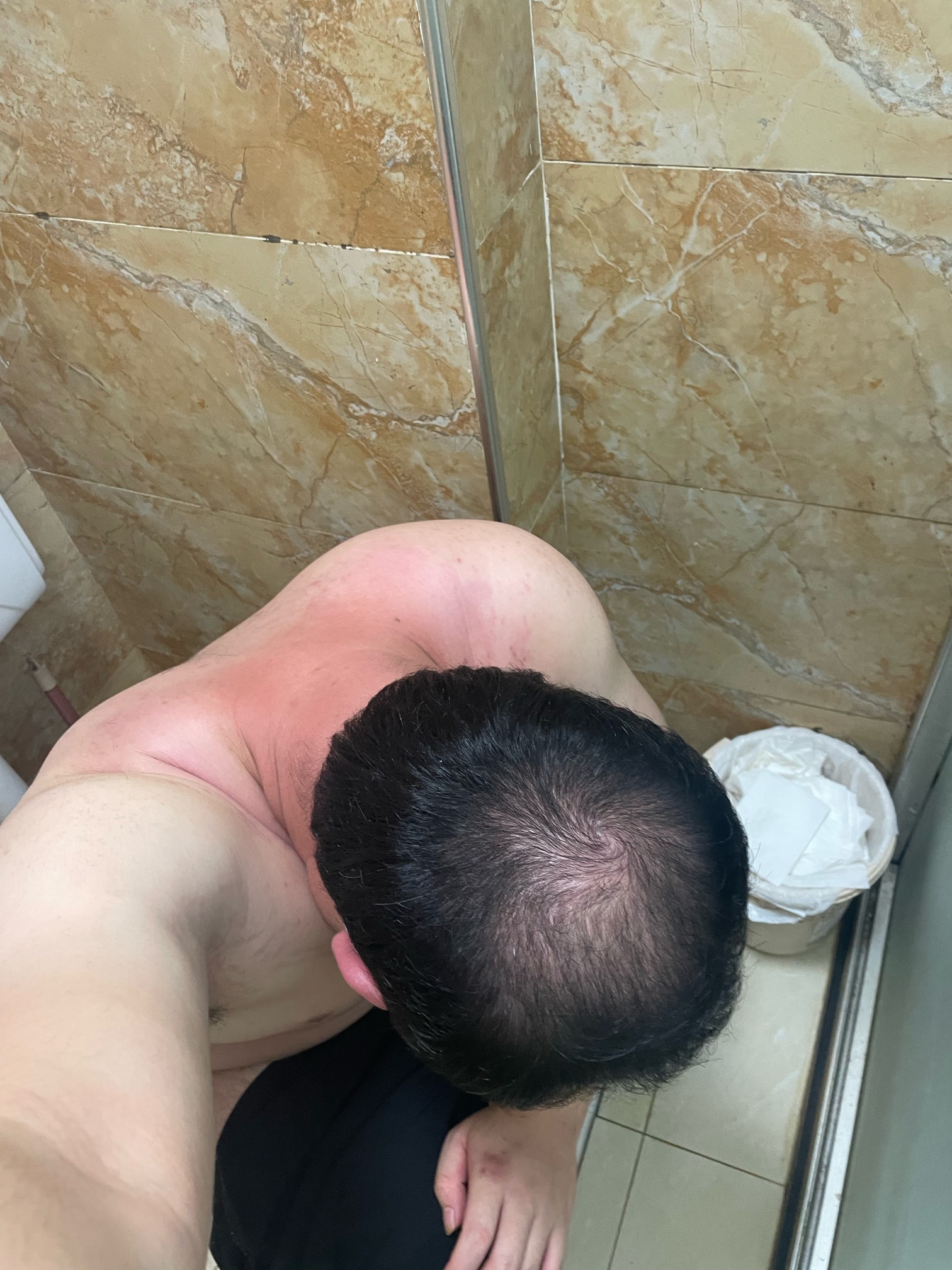 遗传脱发无解，30就掉成这个样子!准备假发把

52 / 作者:寻梦青年2 / 