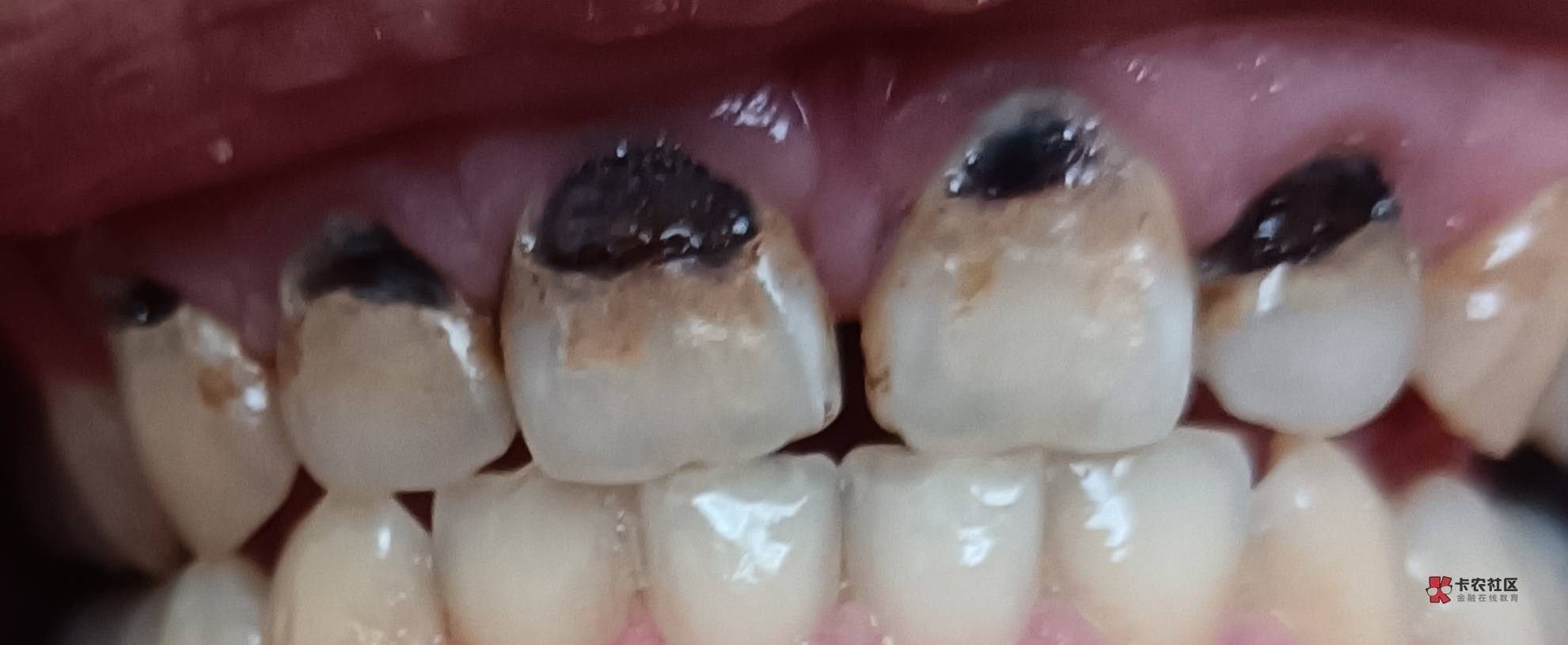 28岁，男，因为懒3年不刷牙，喜欢喝可乐跟甜饮料，牙齿烂了5颗，每天都很焦虑，整晚整91 / 作者:挂壁老哥饿了mm / 