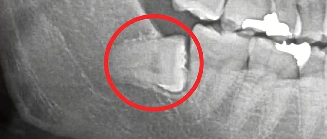 今天去拔横着长的智齿，是一个年纪差不多25岁左右的女孩子来操作的，看胸牌职位是副主21 / 作者:挂壁老哥饿了mm / 