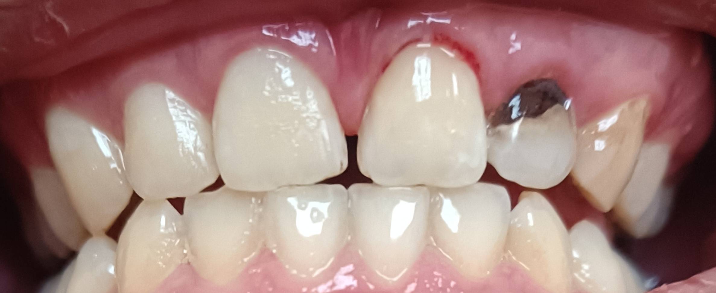 老哥们，上次我补了4颗牙，还有一颗问了好几个医生不敢给我弄，都叫我做根管治疗，说75 / 作者:挂壁老哥饿了mm / 