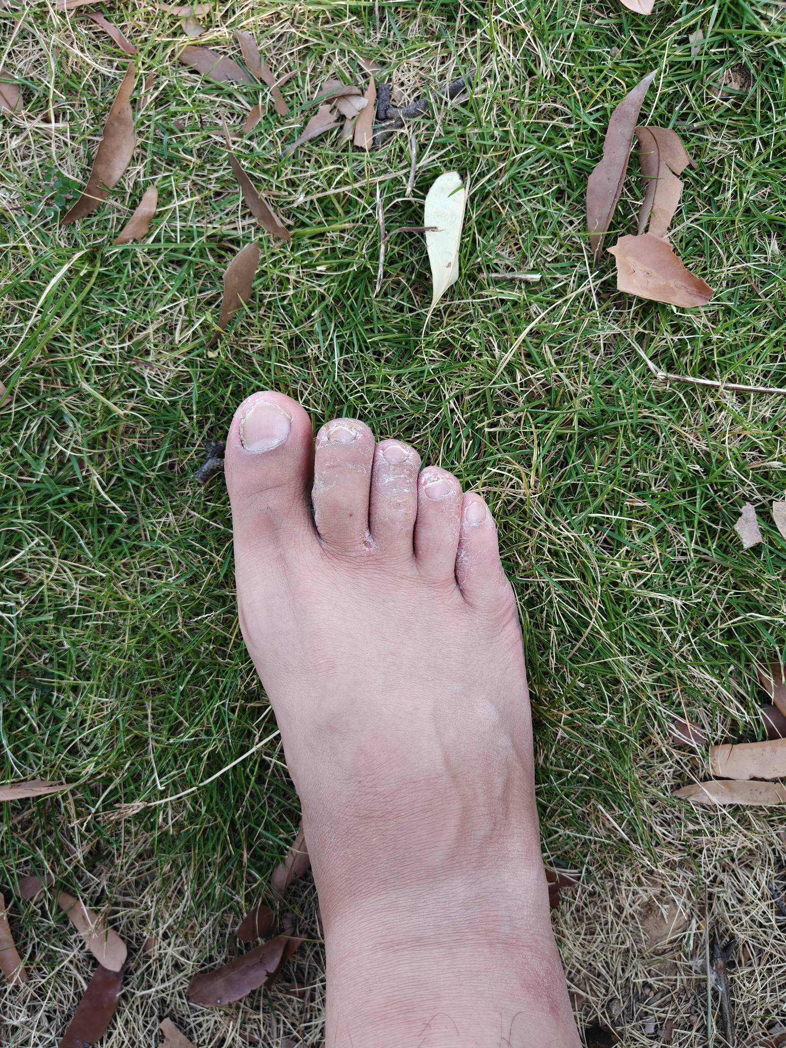 挂b东莞穿一夏天拖鞋  经常洗脚也不擦干 不知道怎么搞成脚气了 有办法治愈吗老哥


29 / 作者:我不再想你了 / 