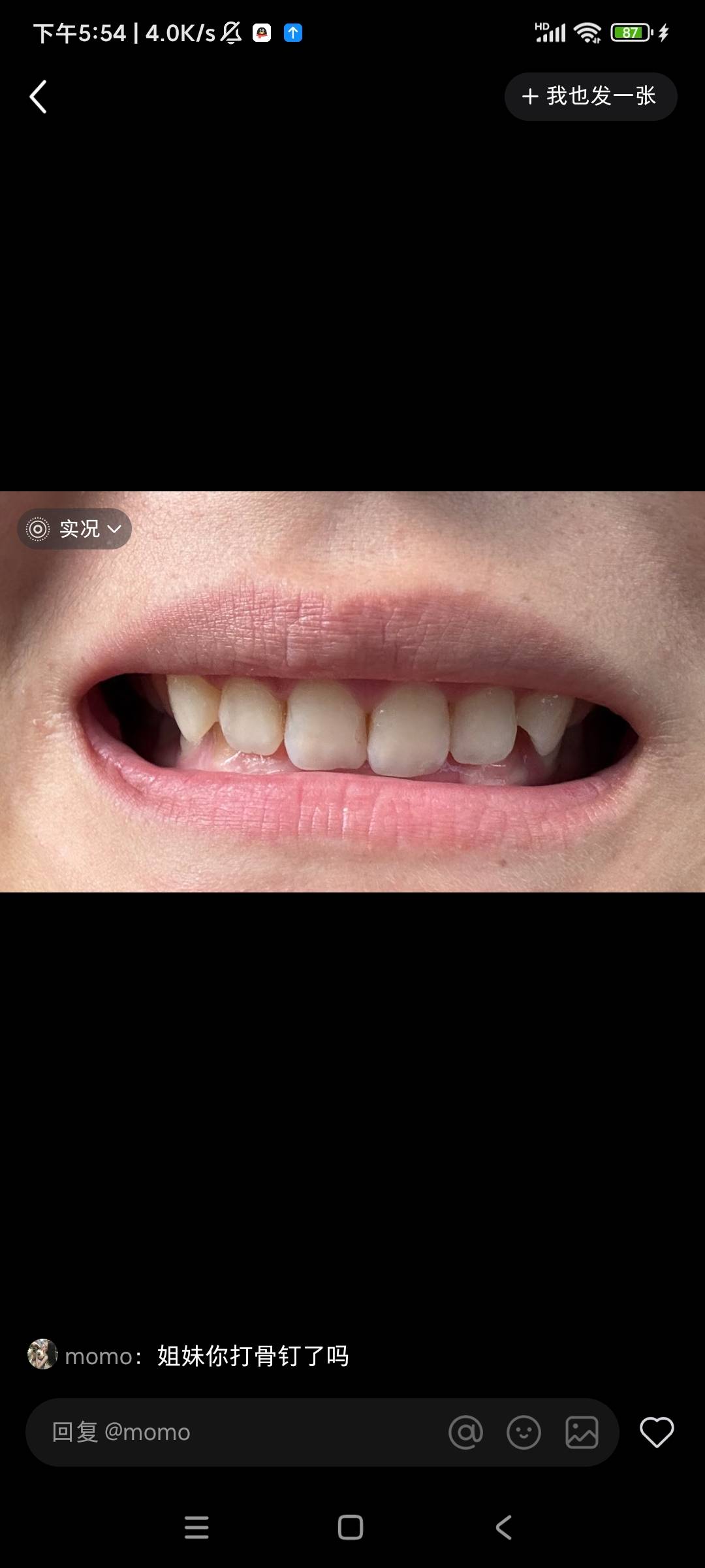 兄弟们，好烦，最近才发现上牙老是抵到下牙龈，出血红肿，查了下才知道叫啥深覆合，去93 / 作者:竹舟 / 