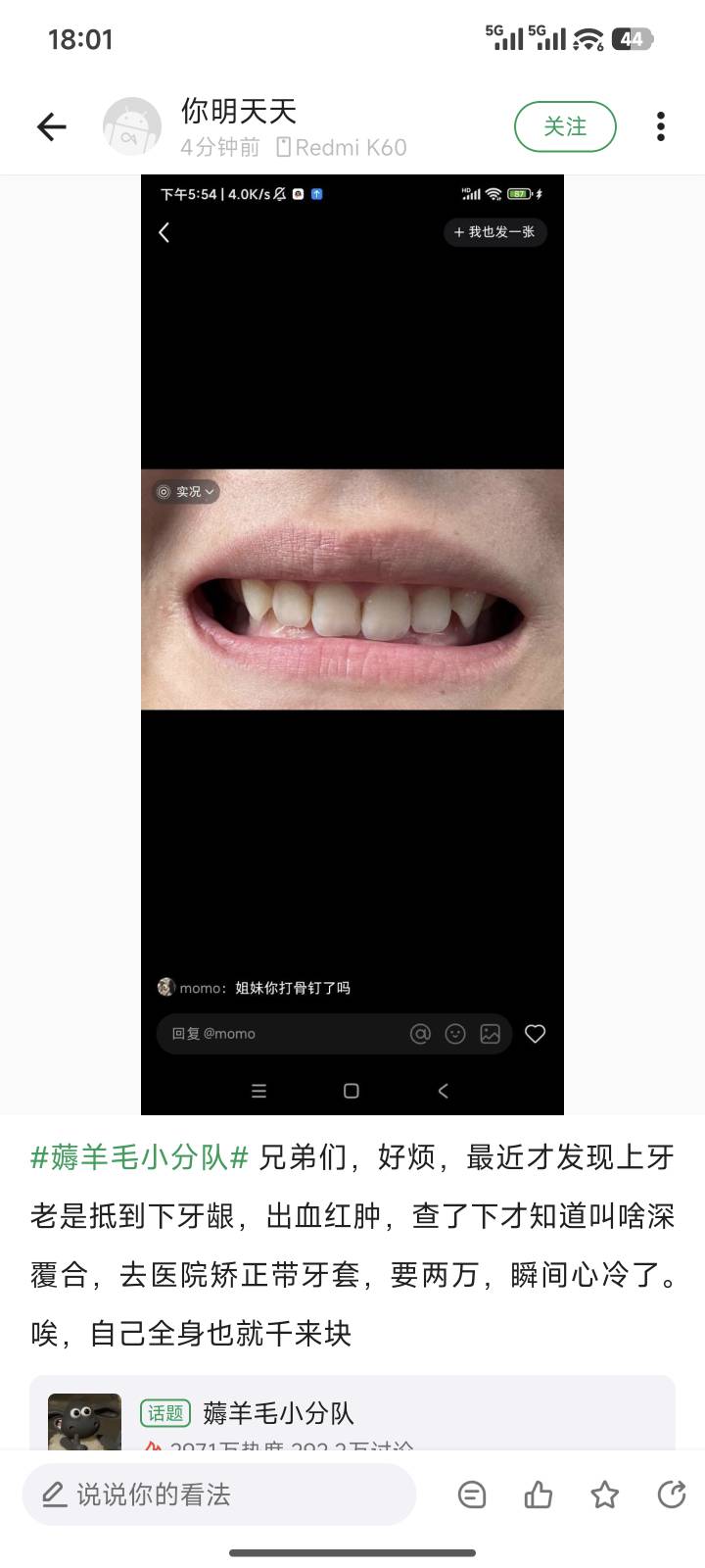 兄弟们，好烦，最近才发现上牙老是抵到下牙龈，出血红肿，查了下才知道叫啥深覆合，去7 / 作者:爱幻想的肺雾 / 