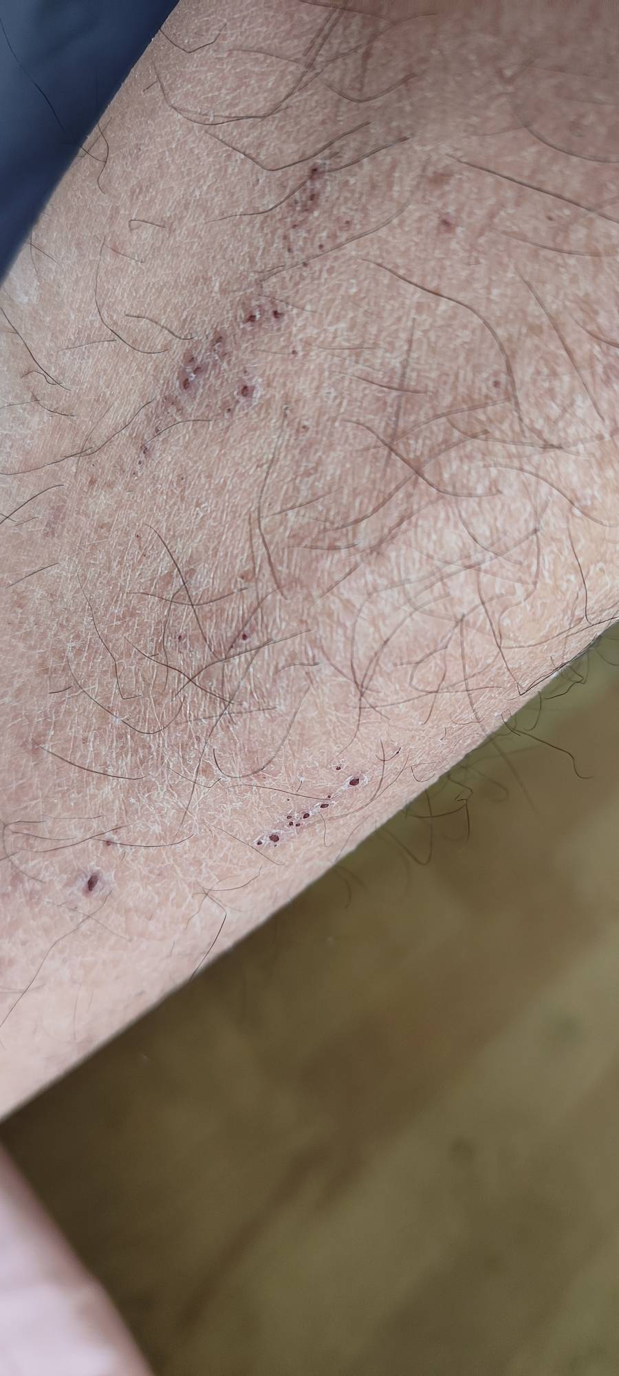 这就是臭虫咬的伤口，密密麻麻这叮叮那叮叮



17 / 作者:我不会. / 