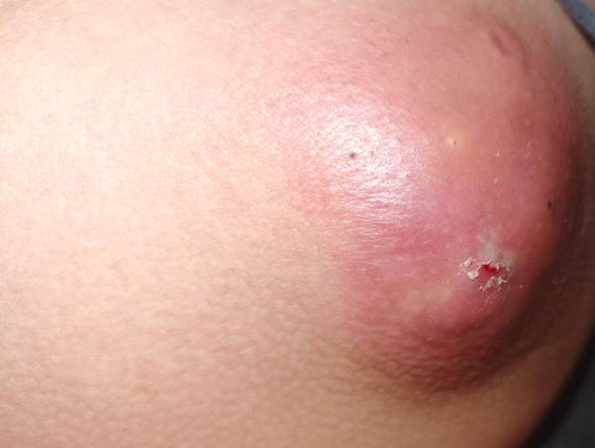 咋天被我扣了一个小洞，刚刚躺着一直玩手机没注意刚起床裤子碰到大腿才知道破了，脓水73 / 作者:季伯长 / 