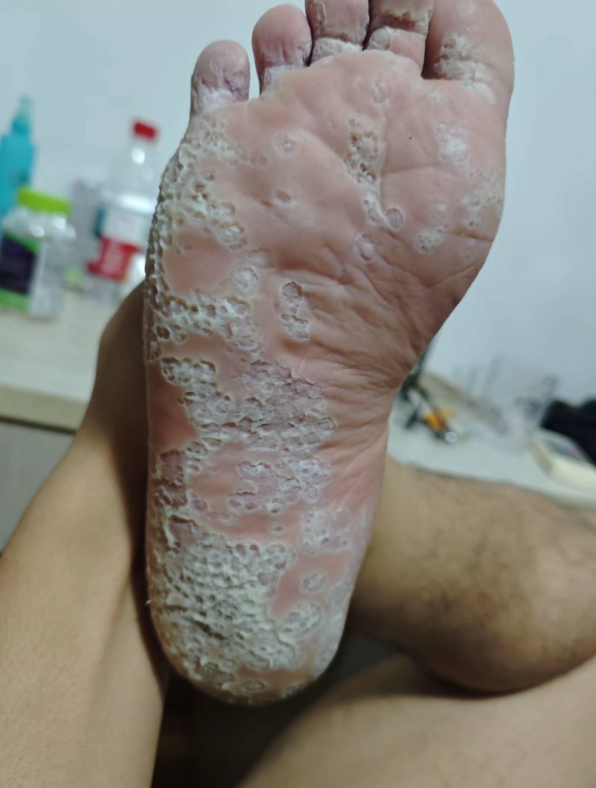 老哥们我这脚还有救吗

32 / 作者:几把毛都没有绝望了 / 