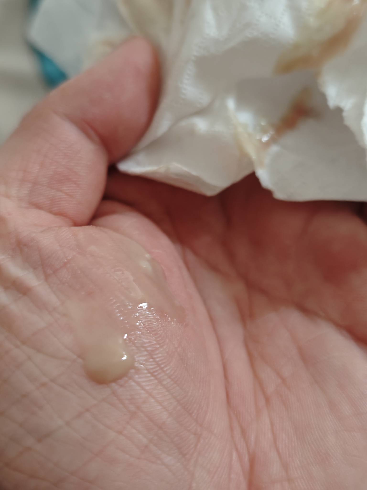 脖子上鸡蛋大的一个脓包别我挤破了，要命

80 / 作者:露西亚的鱼 / 