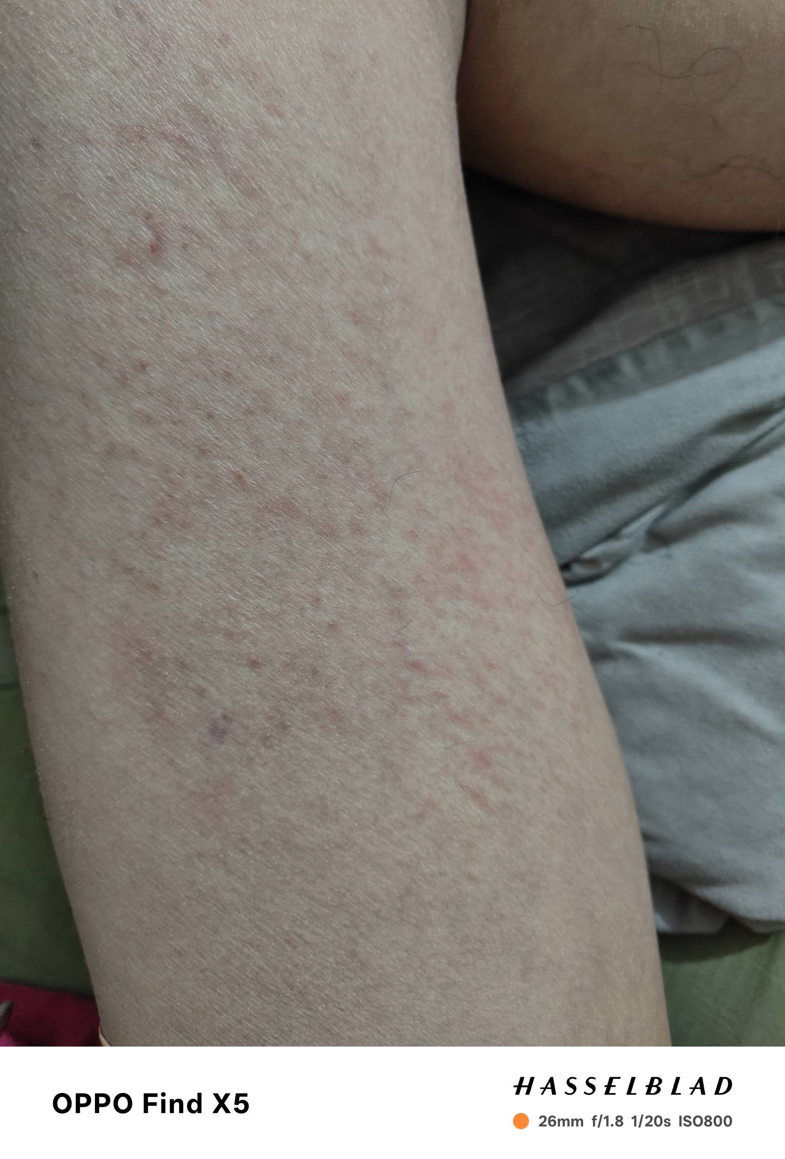 老哥们，来到这个厂里干活就这样了，每天干的活很脏。累似煤矿那么黑。我这是过敏了还73 / 作者:北辰雨墨 / 