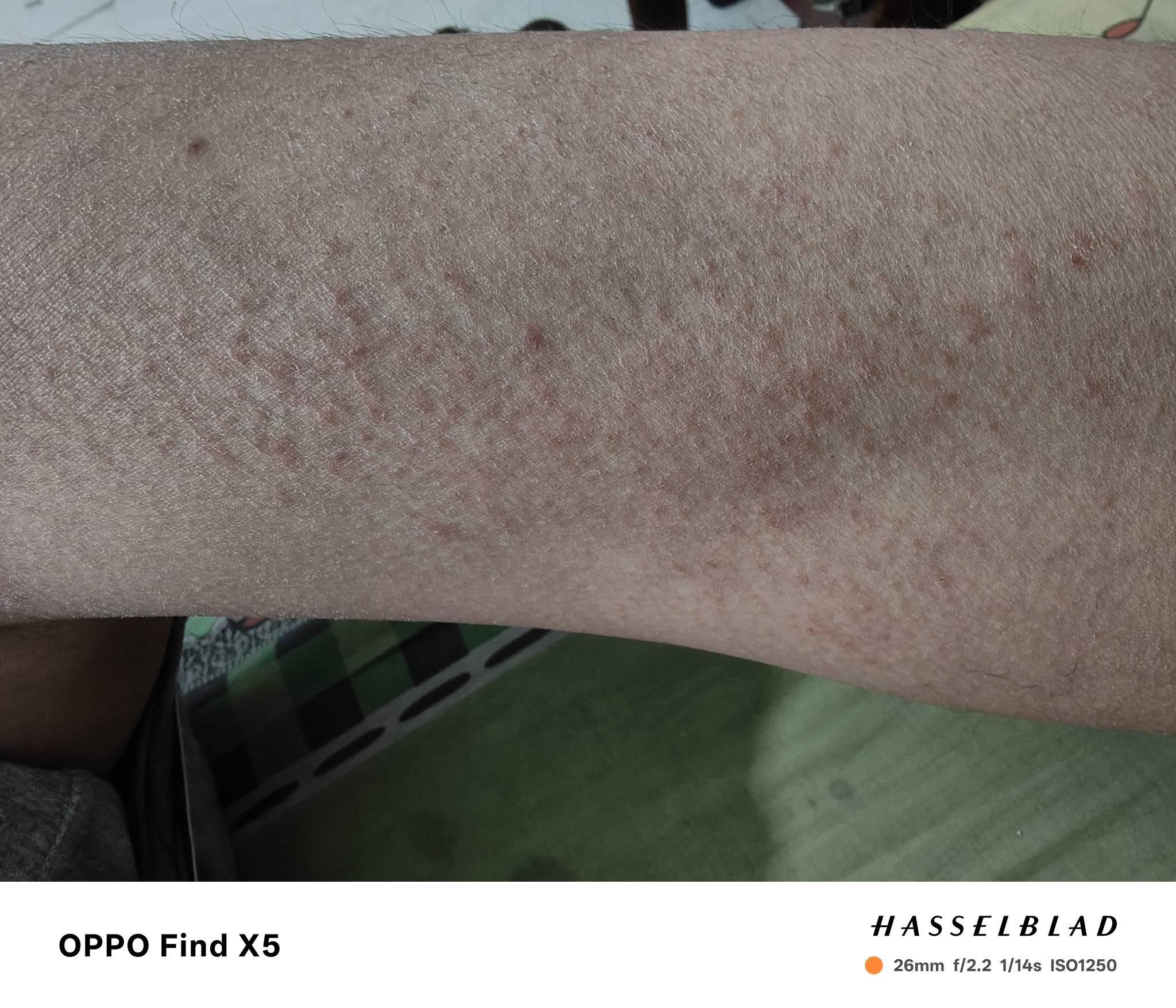 老哥们，来到这个厂里干活就这样了，每天干的活很脏。累似煤矿那么黑。我这是过敏了还34 / 作者:北辰雨墨 / 