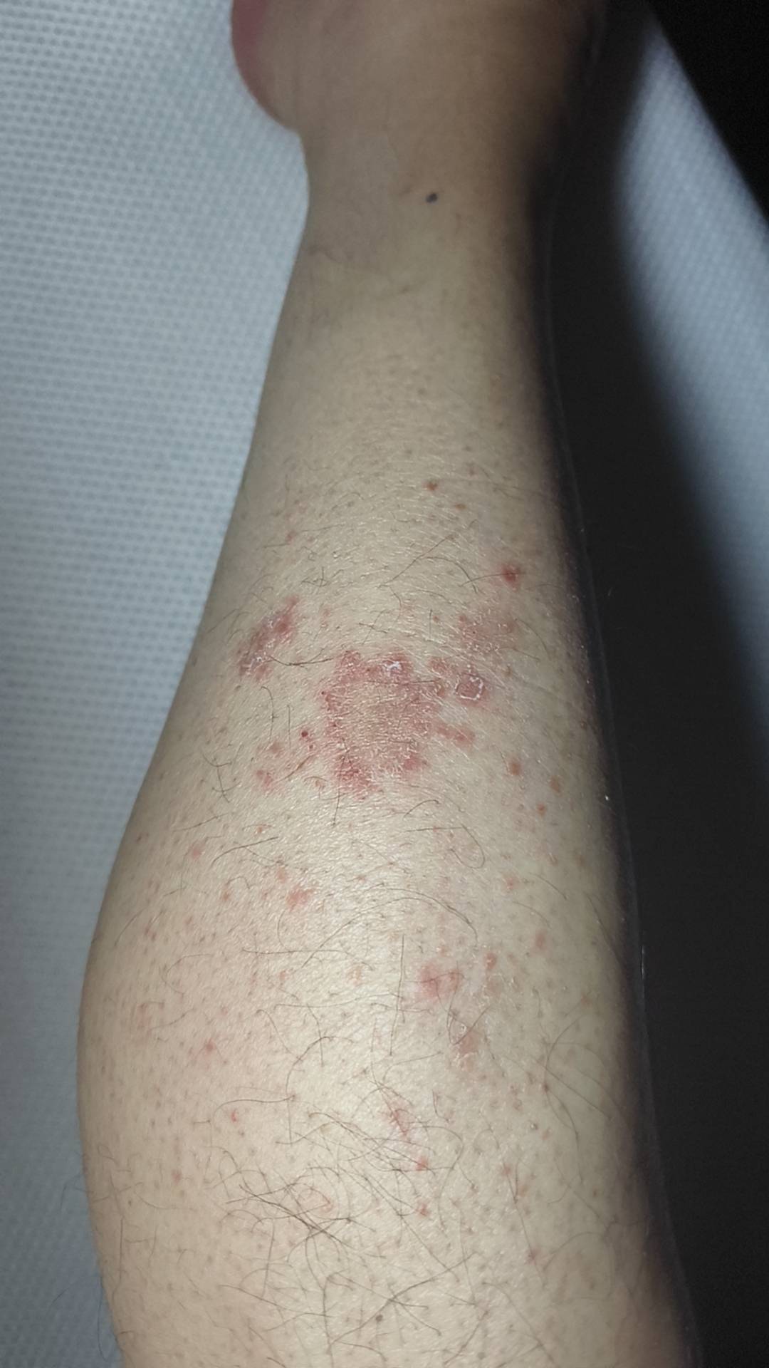 老哥们有点慌了 两只脚上都有 其他地方没有 也没有其他症状



17 / 作者:男人永卟言败 / 