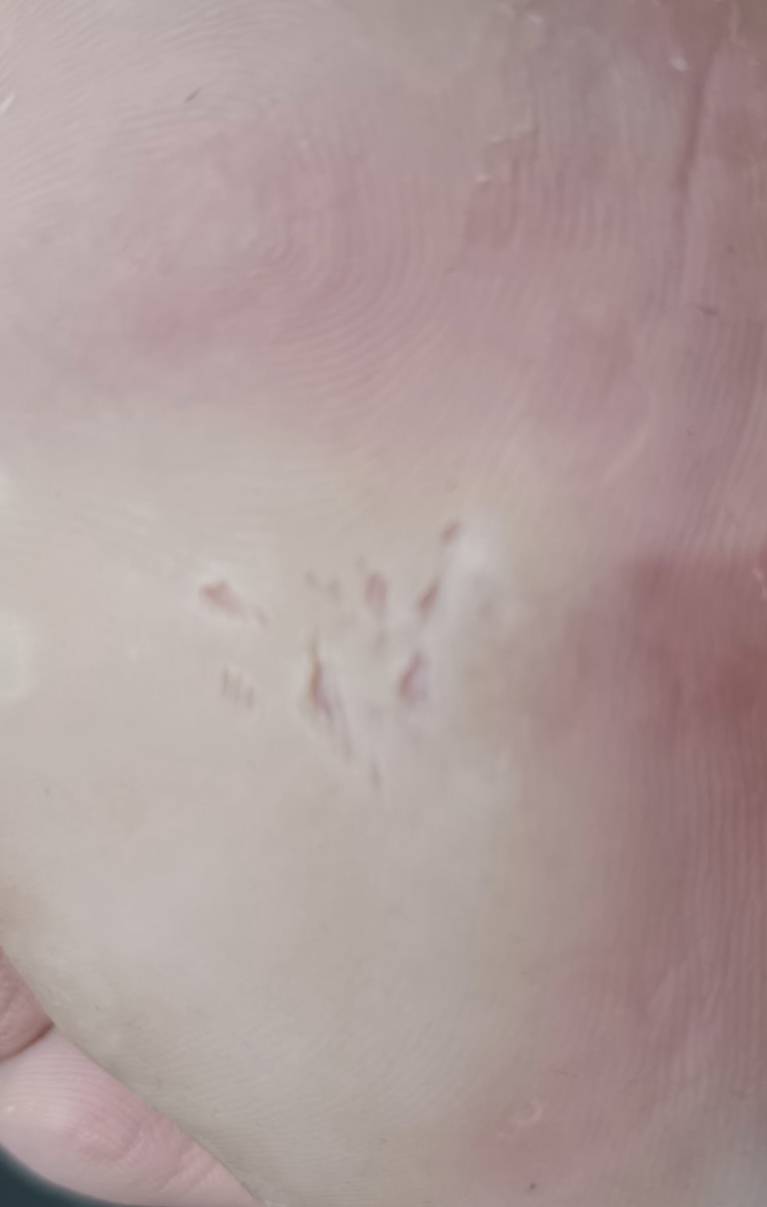 老哥们，脚心有小坑，有没有懂哥

64 / 作者:随缘7777777 / 