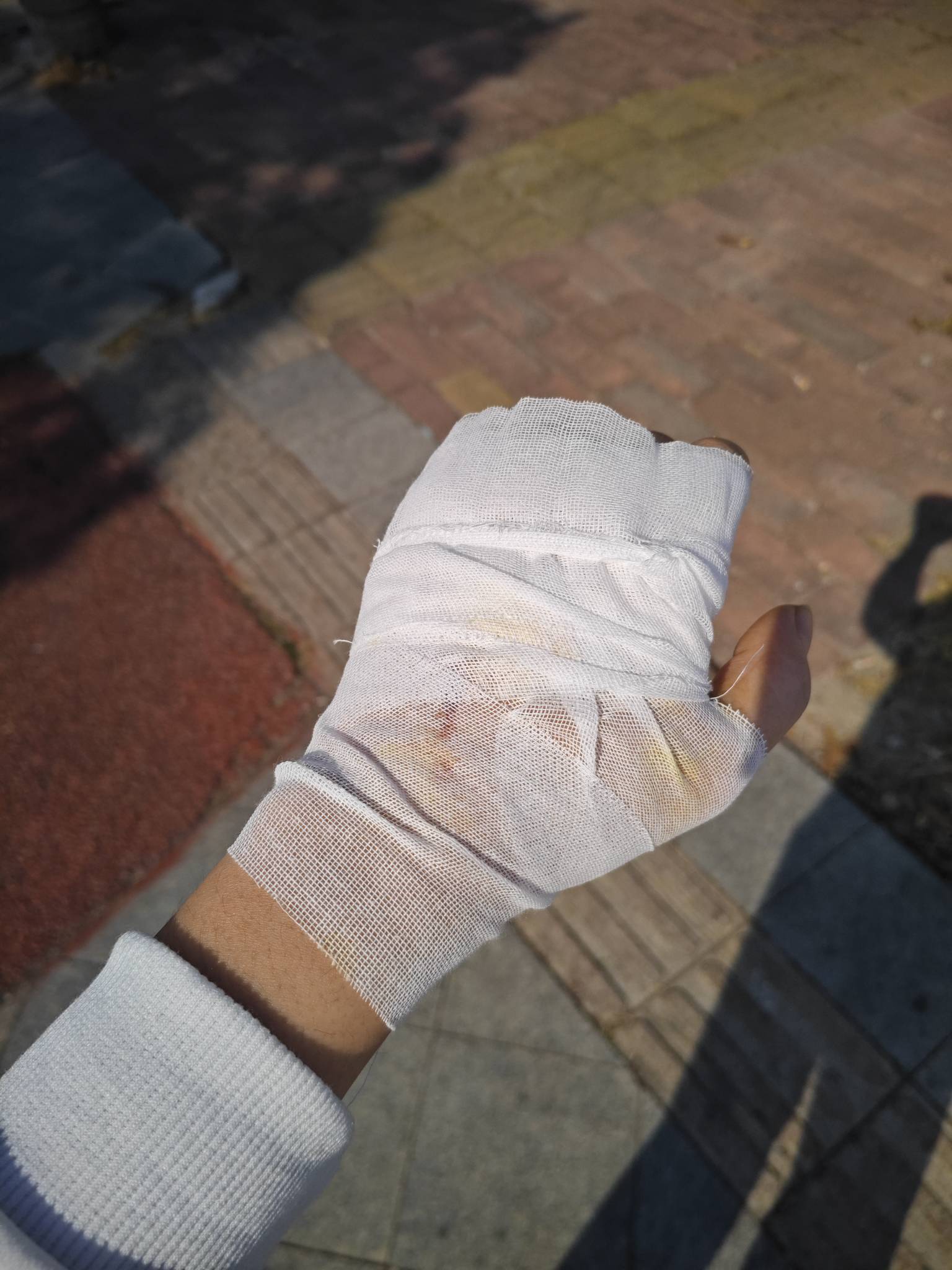 老哥们，前天狂躁症症发作自己给自己手掌捅了好几刀，缝针麻药加破伤风花了六百多了，61 / 作者:大奶奶胸你拳头 / 