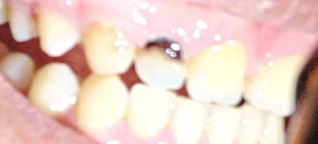 补那两个小半边的牙有那么便宜吗？听这些老哥说美团上面可以去补，就是这个没有烂到根38 / 作者:挂壁老哥饿了mm / 