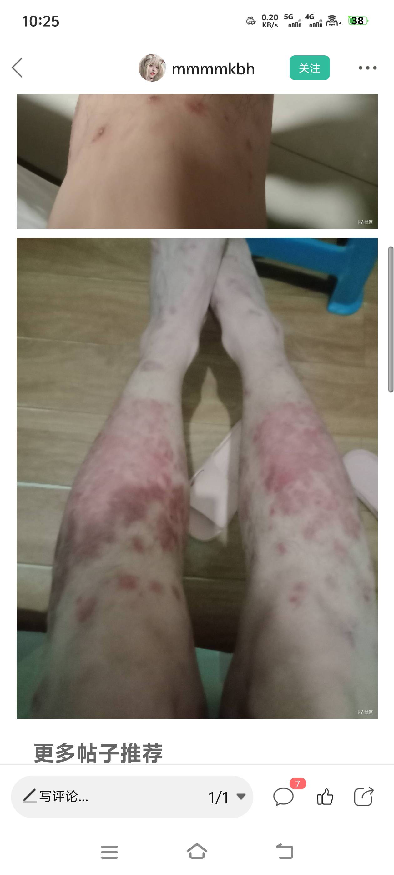 老哥去医院看看吧估计是牛皮癣


13 / 作者:大王不要不要 / 