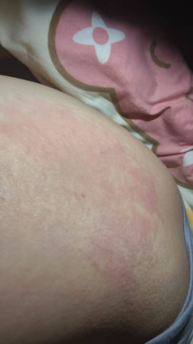 老哥们这痒了好几天了，这也不是荨麻疹啊，就两个地方痒，大腿两侧

77 / 作者:挂比了救我鸭 / 