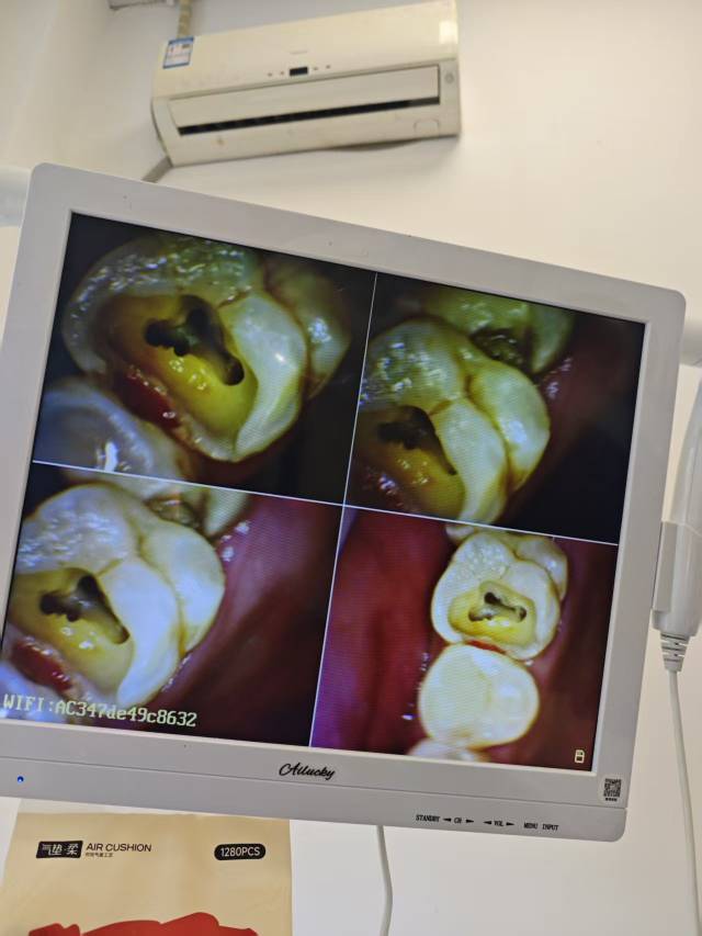 老哥们，你们牙都是好的吗，我的坏了两个了，都补上了，不敢吃硬的

7 / 作者:撸毛11 / 