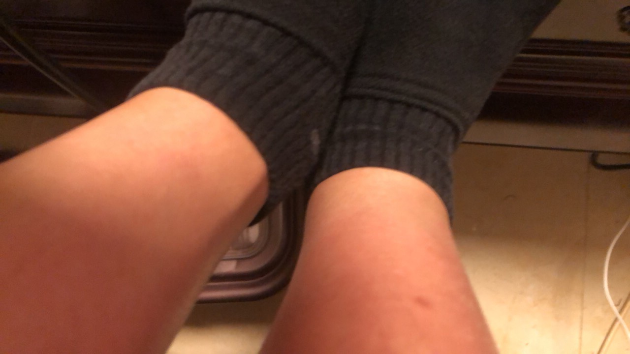 惨了 不知道什么问题 一只肿一只不会

52 / 作者:广东小帅哥 / 