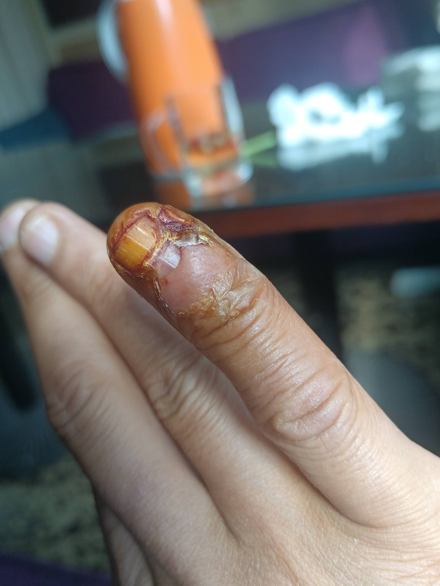 玛德.惯是真难改，之前咬指甲搞的指头炎花了六百块，十几天了还没好利，看着电视剧又23 / 作者:蛋黄酱 / 