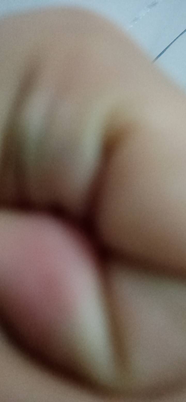 老哥们，你们去割过痔疮没有？有交城乡居民医保一般需要多少钱？我指的是正规医院，

60 / 作者:挂壁仔等着吃饭 / 