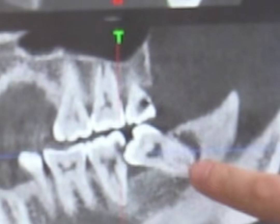 可恶啊，刚赚了点钱就要花出去了，横着长得牙齿把我大牙顶坏了，把阻生齿拔了之后，那25 / 作者:挂壁老哥饿了mm / 