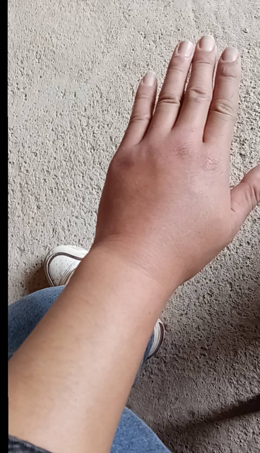 两天装了两箱蜂回来，被蜇的不像样了



5 / 作者:永恒yi / 