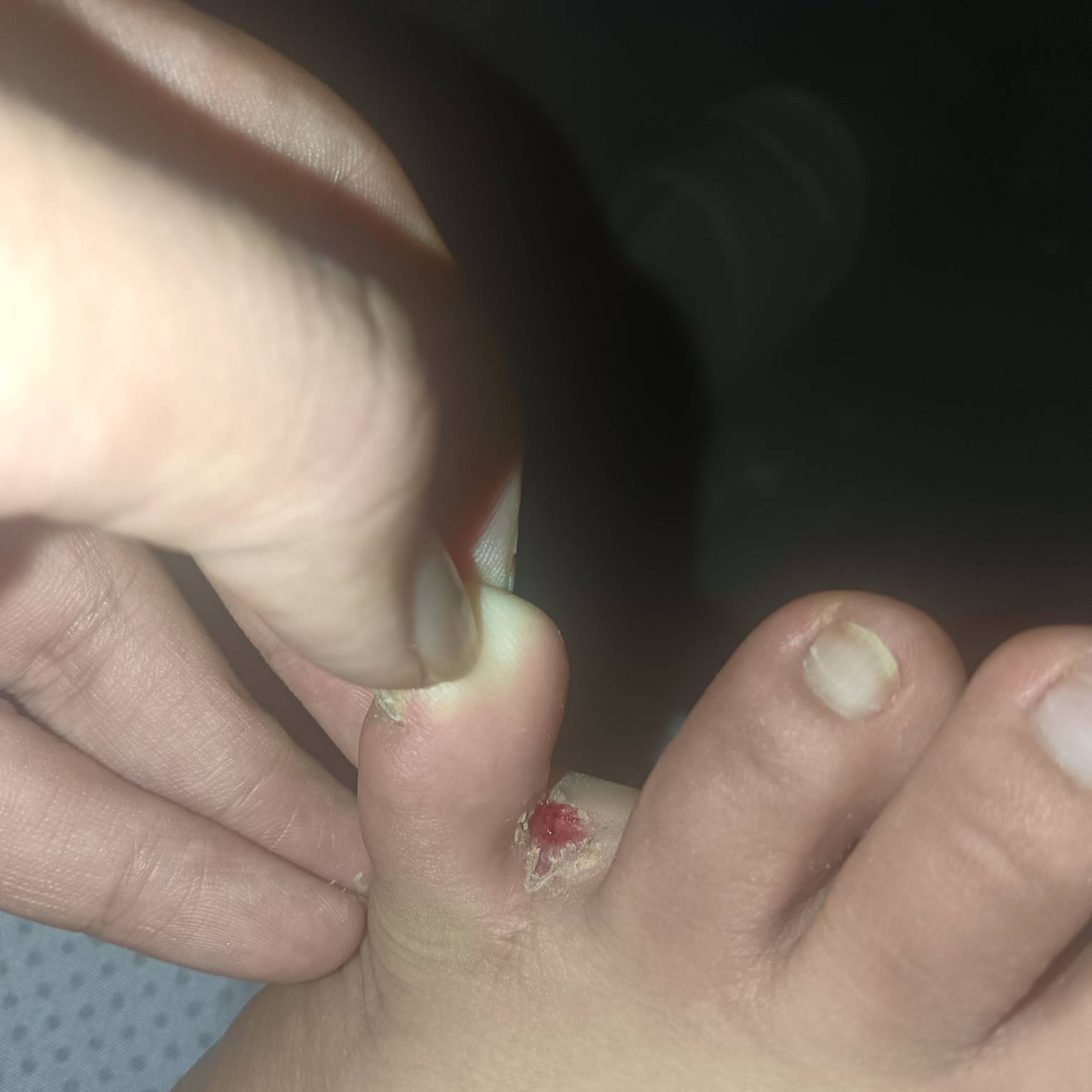 粗事了老哥们，我的脚怎么烂掉了。我还以为被蚊子咬了，痒的不行

91 / 作者:YukiXX / 