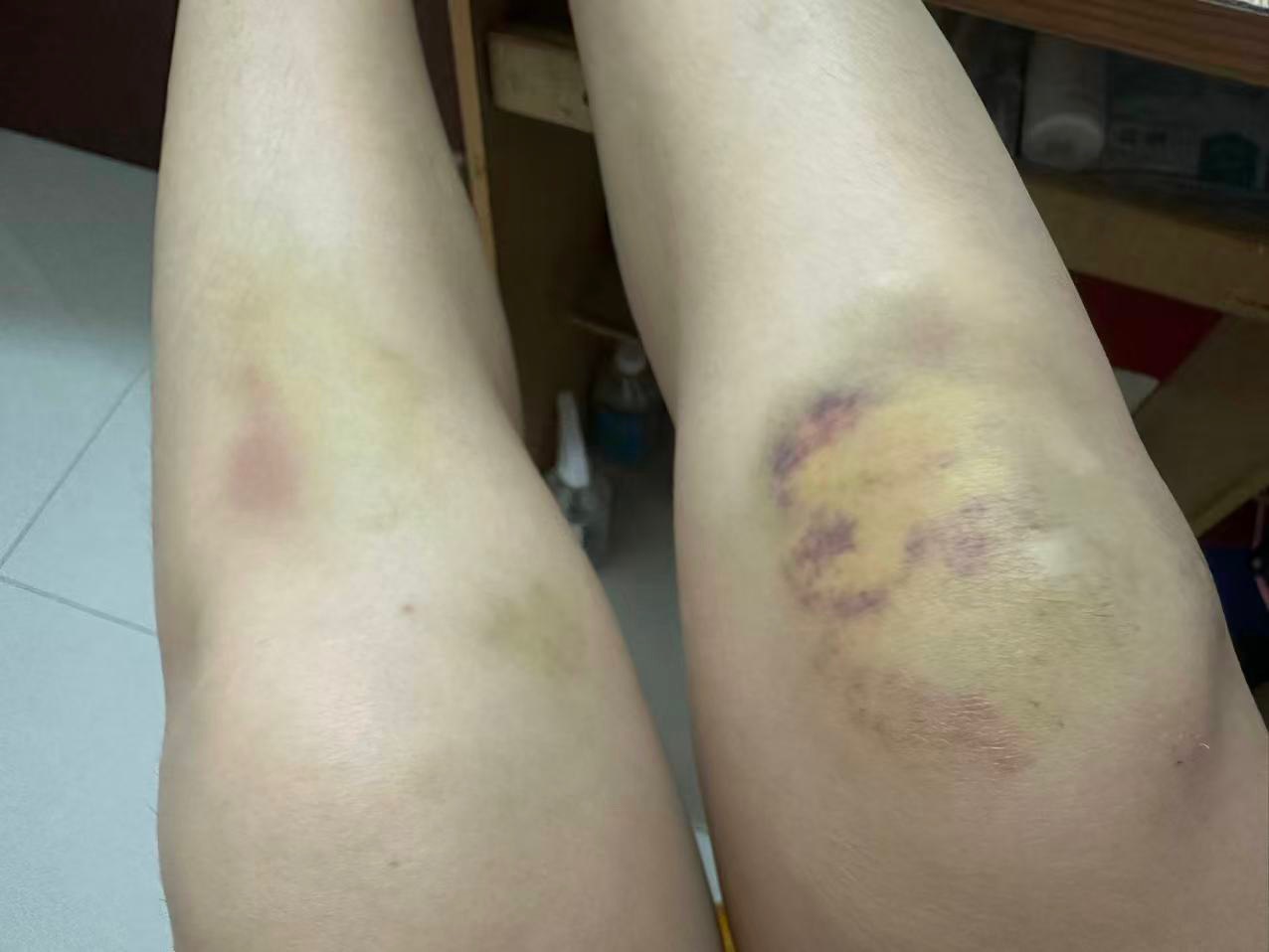 骑车被狗弄摔跤了。狗不牵绳。人跑了。报交警。说找不到人。一直这样好几天了怎么办。59 / 作者:手工店刷朋友圈的虾片 / 